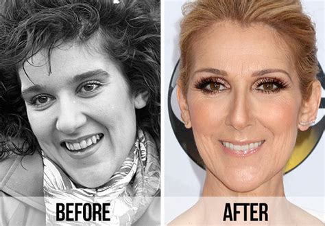 celine dion fake teeth|kylie from porcelain teeth.